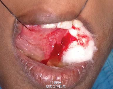 新方法治疗舌尖腺黏液囊肿