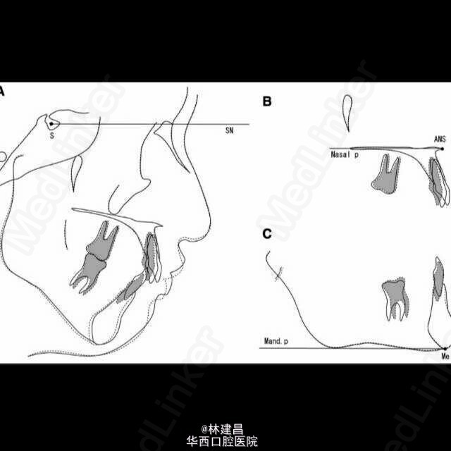 舌侧矫治技术联合舌弓治疗复杂安氏ii类2分类一例