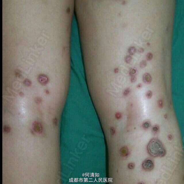 长知识:一组反应性穿通性胶原病临床照片