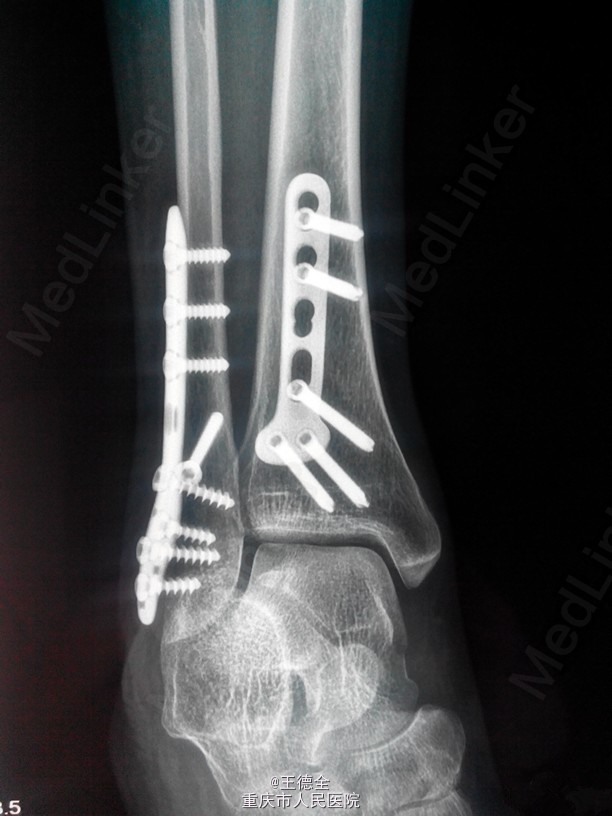 外踝及后踝骨折一例