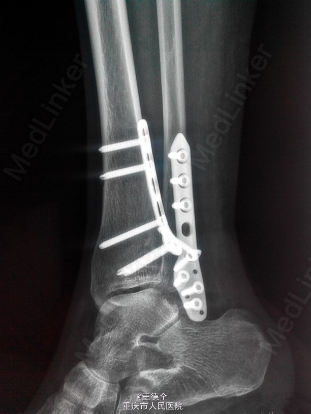 外踝及后踝骨折一例