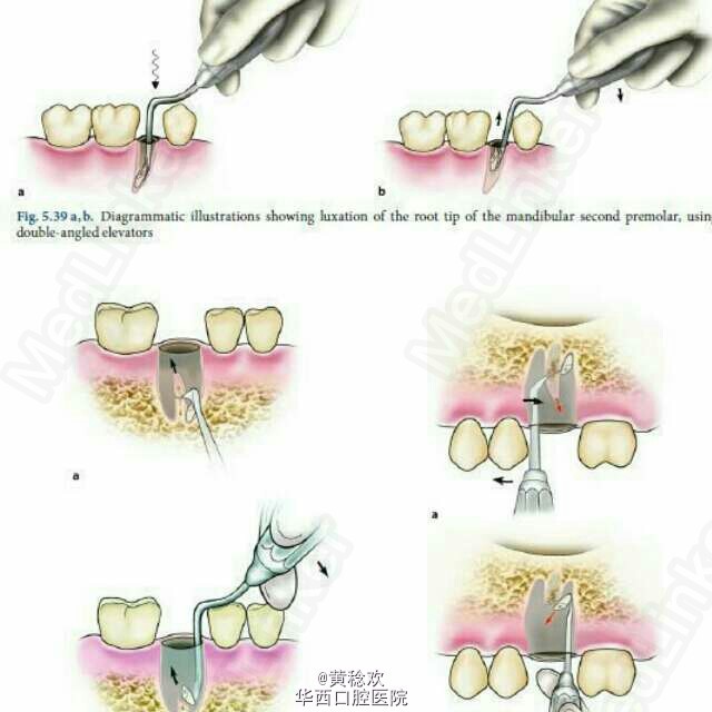 牙槽外科操作示意图分享(一)
