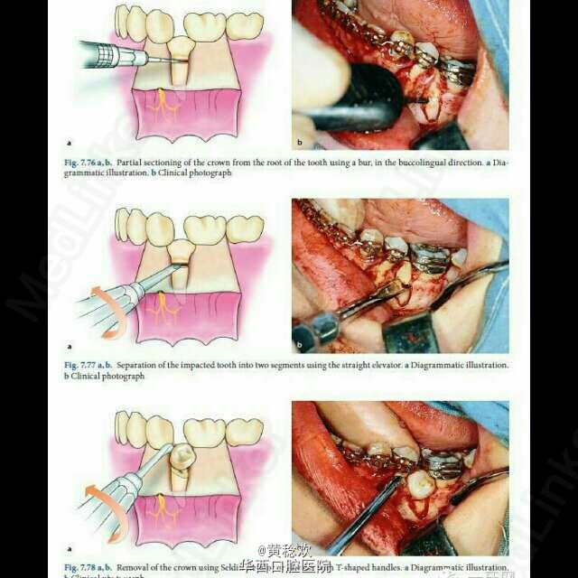 牙槽外科操作示意图分享(一)