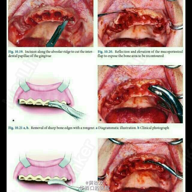 牙槽外科操作示意图分享(二)