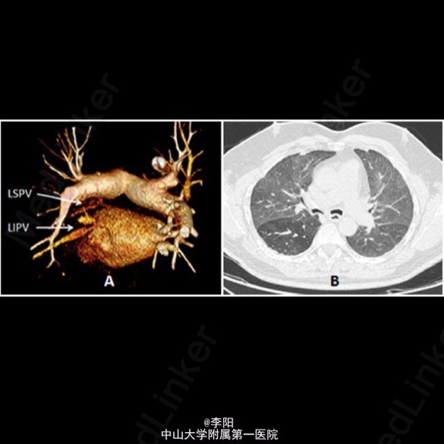 首例self-apposing支架植入治疗肺静脉狭窄