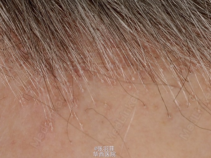 与雄激素性脱发及斑秃鉴别: 前额纤维化性秃发