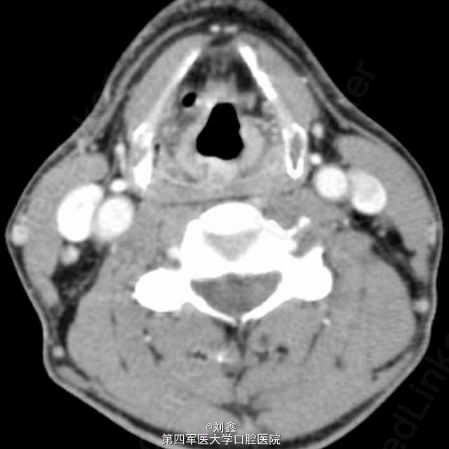 经典病例 罕见的喉结核