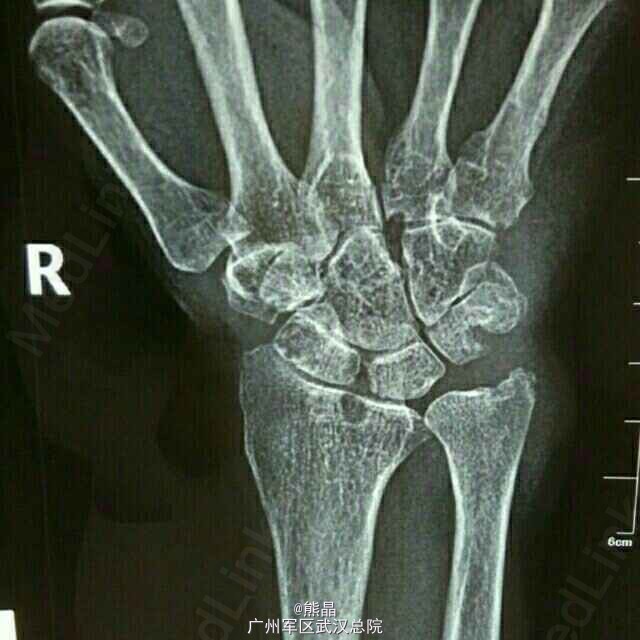 腕关节结核三例