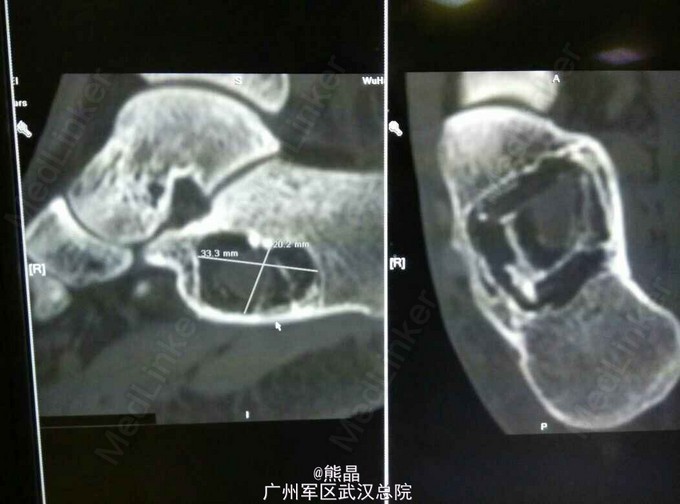 跟骨动脉瘤样骨囊肿