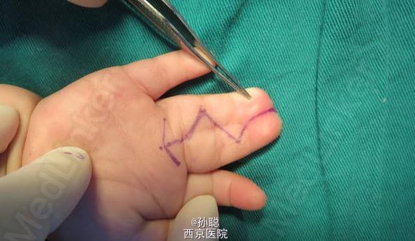 先天畸形:中指并指畸形