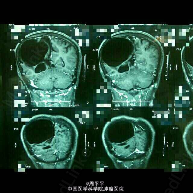 蛛网膜囊肿