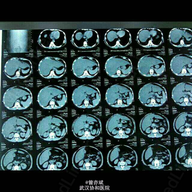 主诉 病史 青年男性患者,ct提示脂肪肝,查体肝下界于脐水平以下三横指