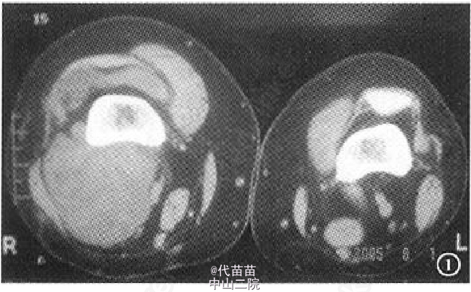 右膝关节色素沉着绒毛结节性滑膜炎1例