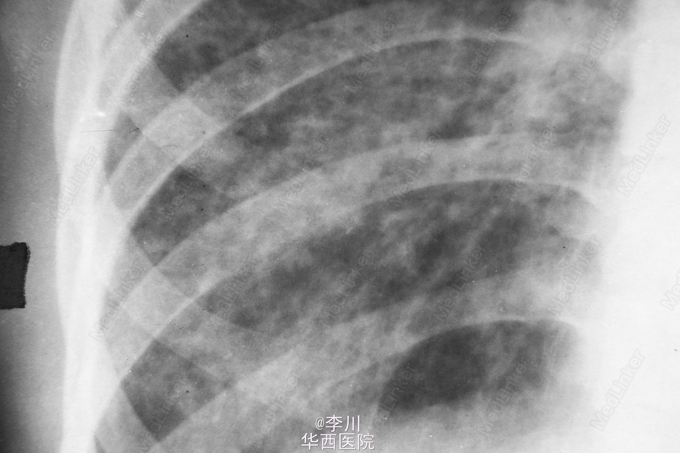 肺结核图片和正常图片,肺结核皮试结果怎么看,肺结核t_大山谷图库