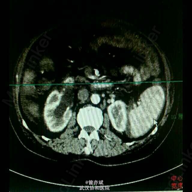 主诉 病史 ct:肾先天发育异常,马蹄肾,双肾下极于脊柱前方互相融合.