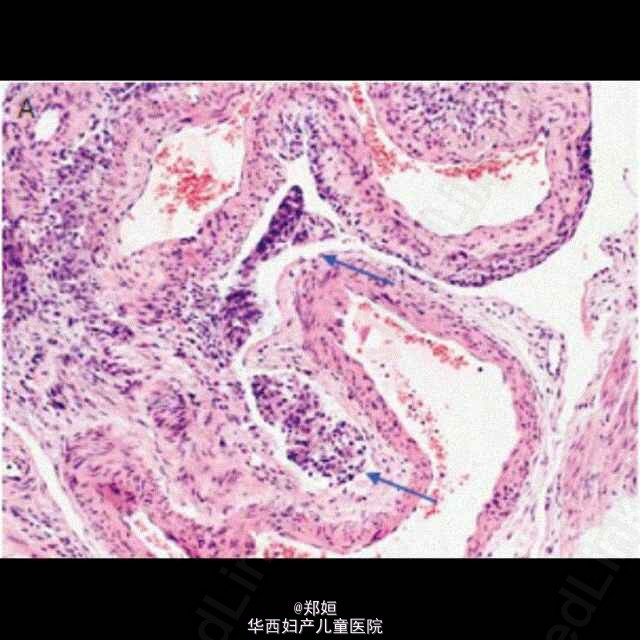 子宫淋巴管平滑肌瘤性血管周围上皮细胞新生物