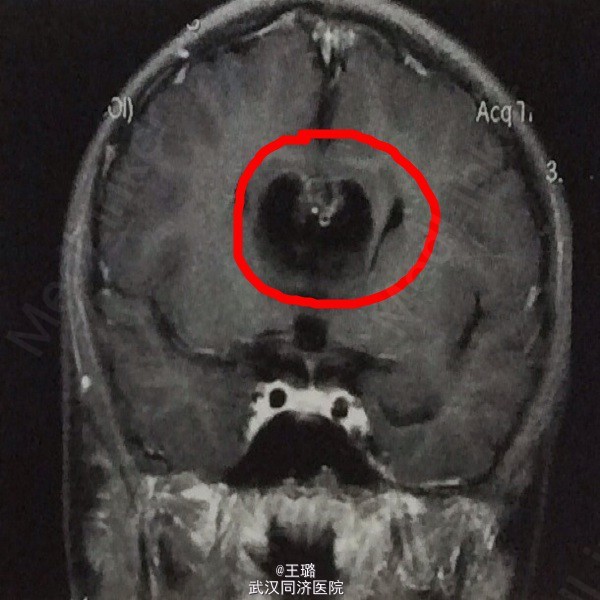 胼胝体缺如伴脂肪瘤一例