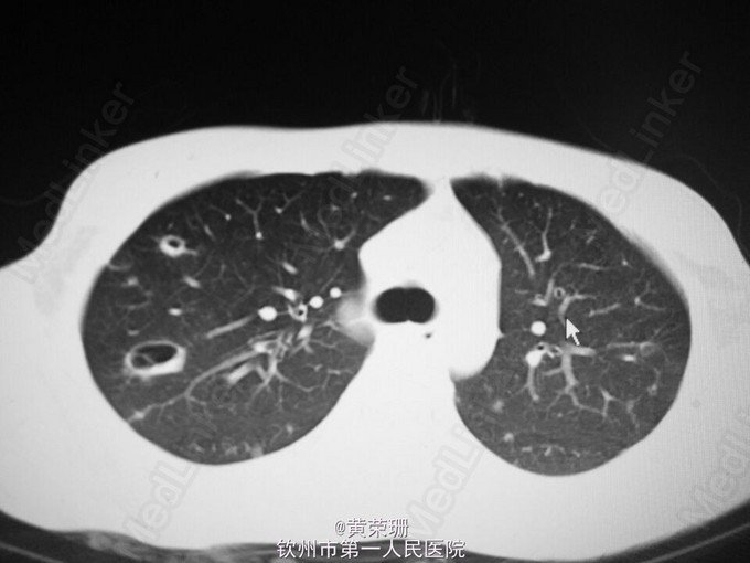 感染性心内膜炎1例医联 感染性心内膜炎1例医联