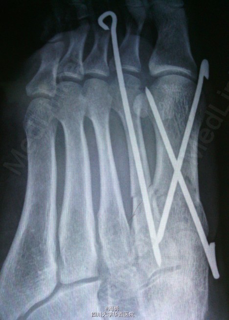 左足第1,2跖骨中近1/3骨折闭合复位克氏针内固定术