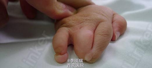 多发手足畸形