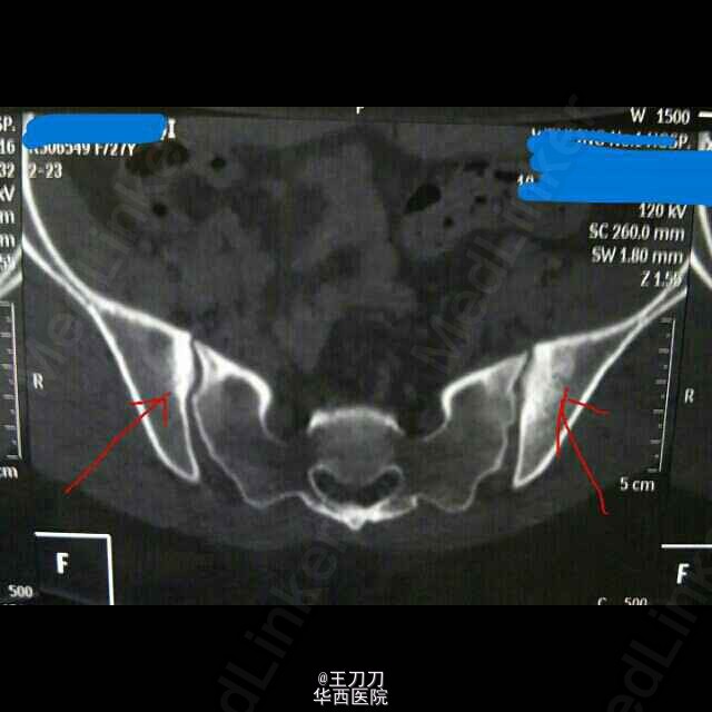 骶髂关节炎1例
