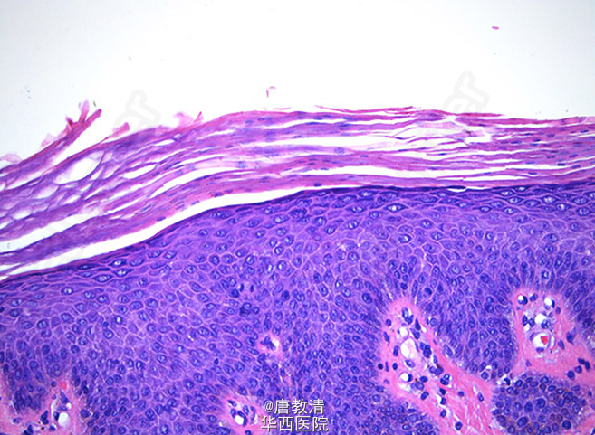 毛发红糠疹1例