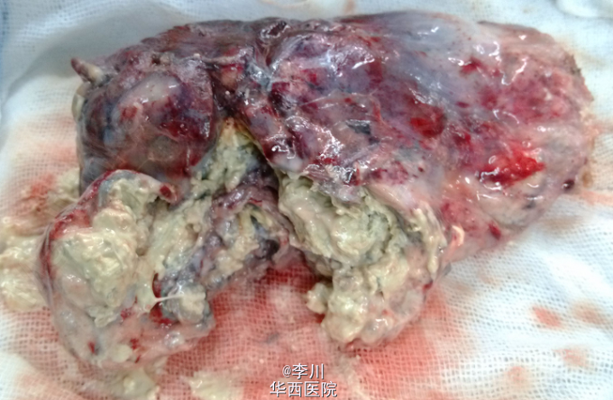 右肺下叶结核球伴毁损一例