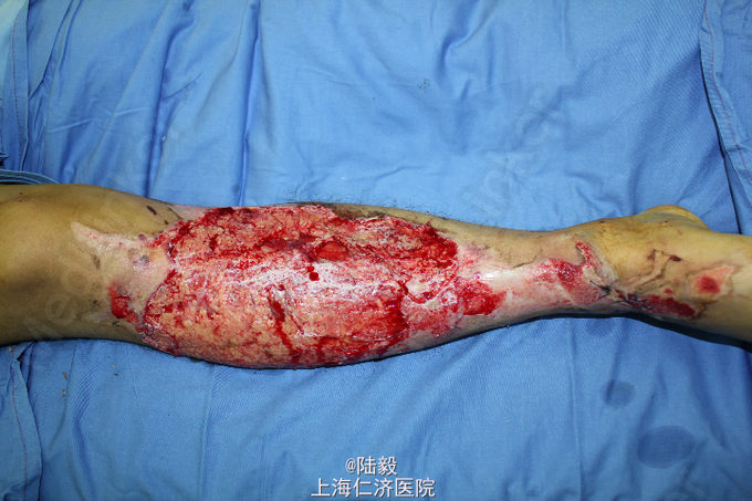 小腿外伤后大面积皮肤坏死游离植皮一例