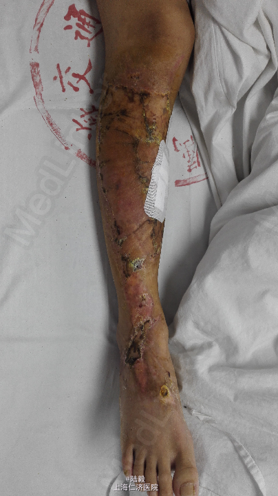 小腿外伤后大面积皮肤坏死游离植皮一例
