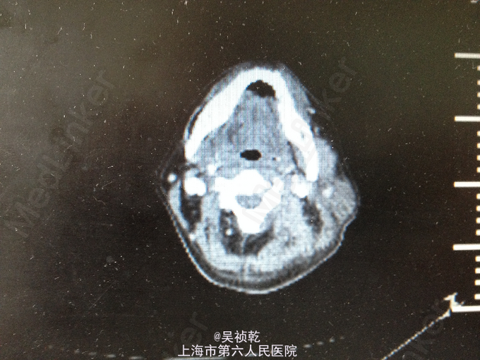 左颈部脓肿,颈部软组织感染,纵膈脓肿形成.2.糖尿病.