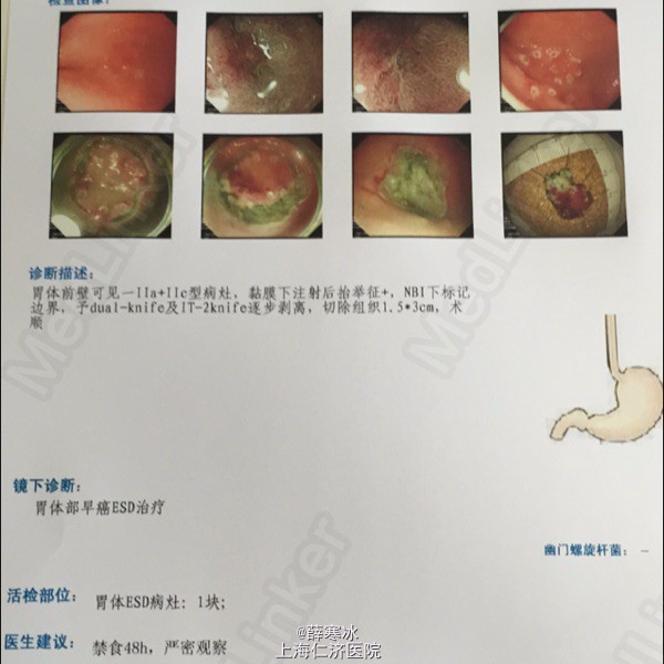 查体 辅查 血液检査(一) 腹部ct(一) 诊断 处理 胃粘膜内癌 随访