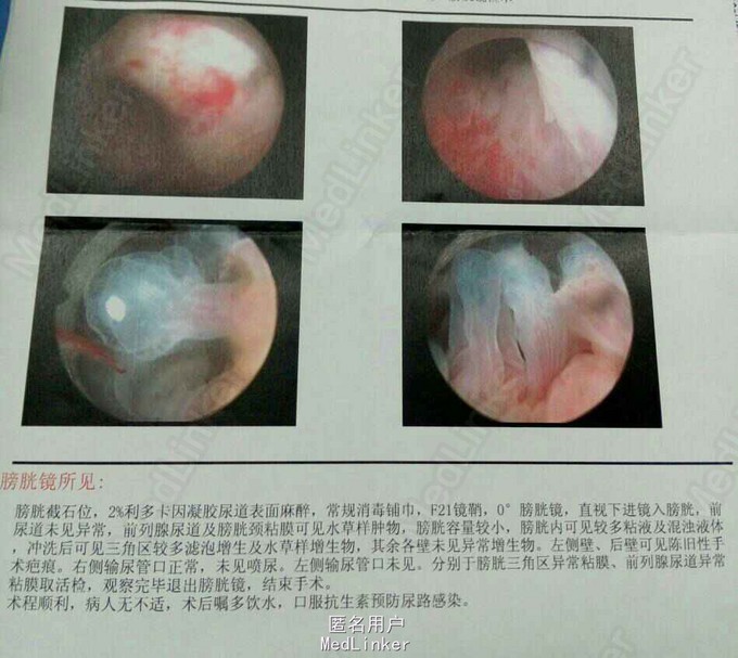 腺性膀胱炎一例