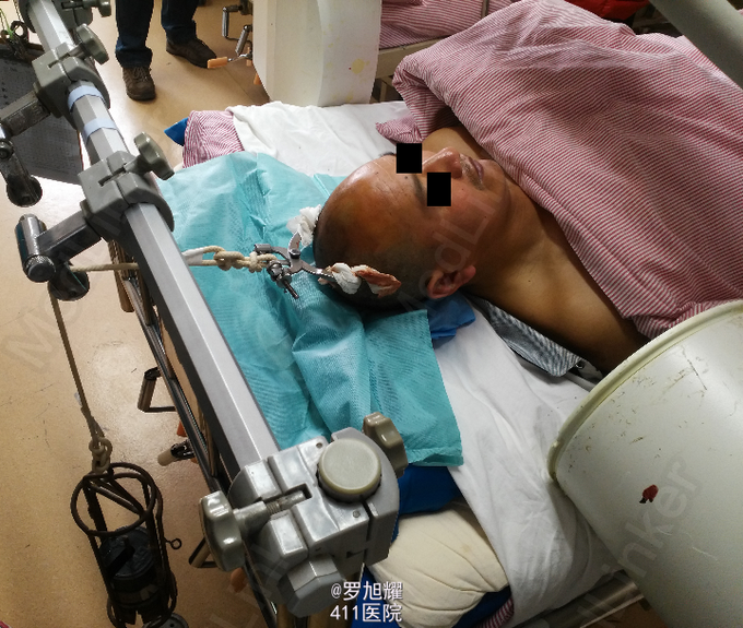 这里主要想讨论一下颈椎脱位闭合牵引复位的问题.