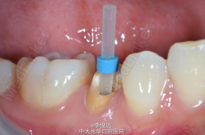 后牙纤维桩修复一例