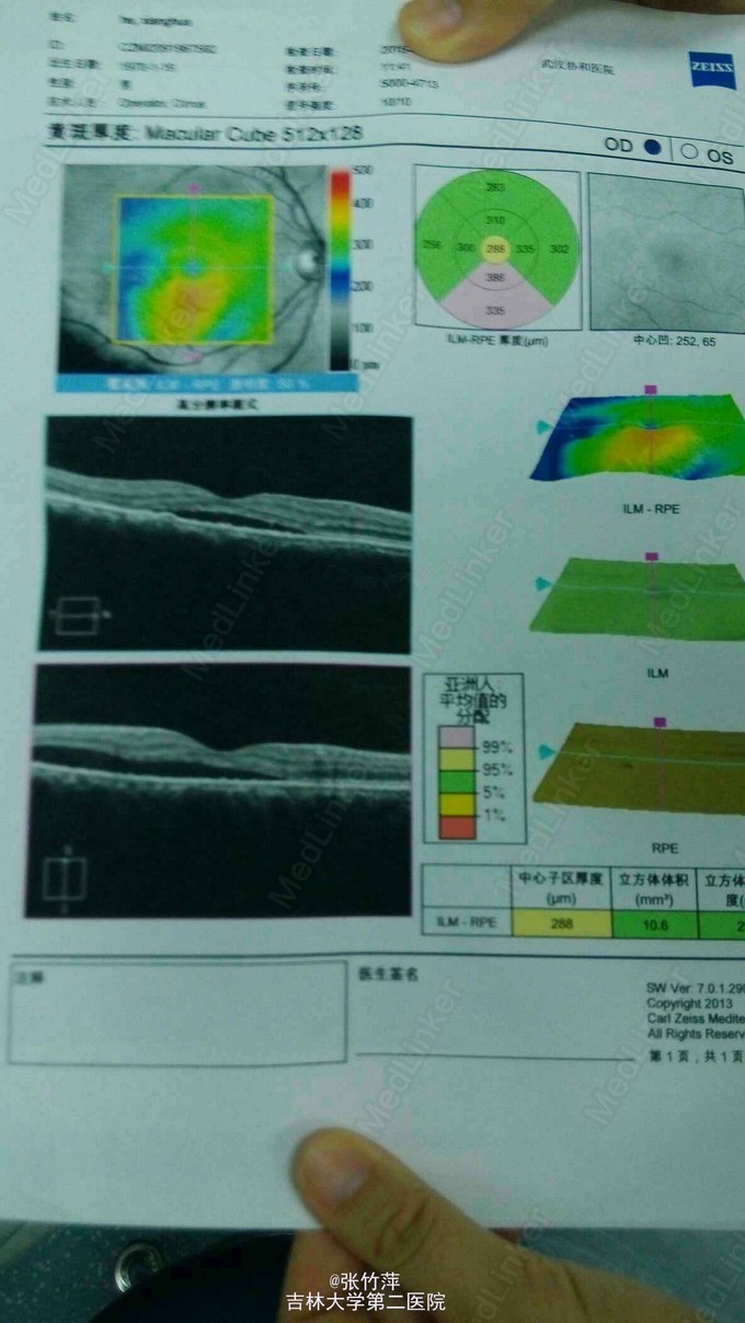 中心性浆液性脉络膜视网膜病变