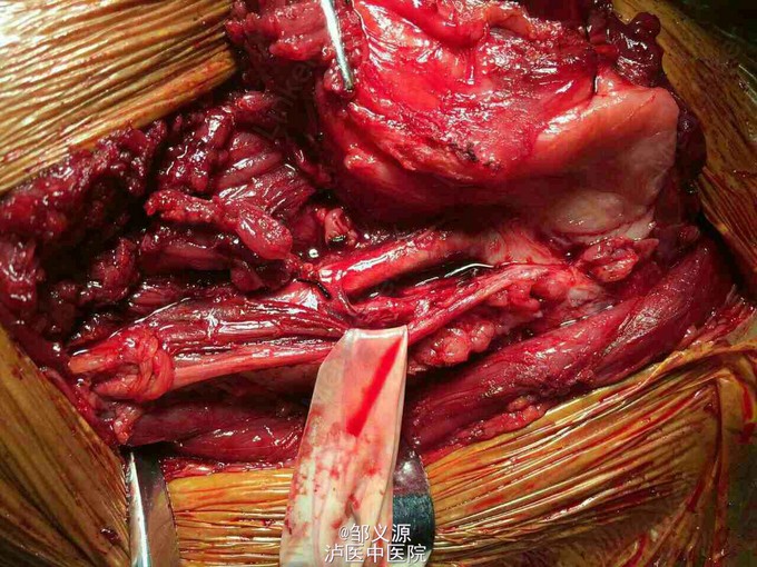 右大腿包块续