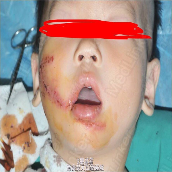 儿童颌面部严重狗咬伤缝合一例