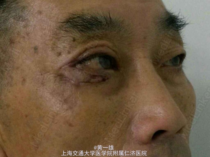 查体 辅查 体检,右下睑外侧外翻,结膜外露充血,溢泪.