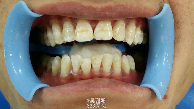 查体 辅查 11,21唇侧牙面中1/3可见一条黄褐色横纹,无缺损,余牙可见