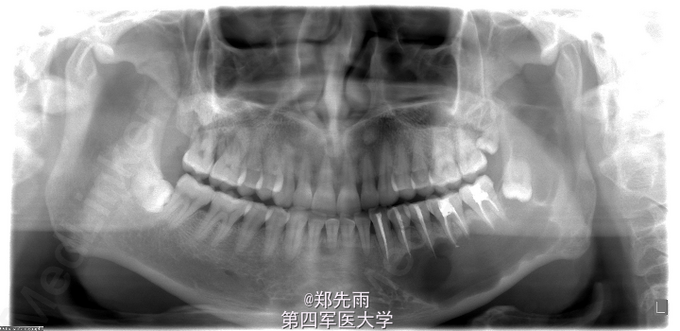 左侧下颌骨角化囊性瘤保守治疗