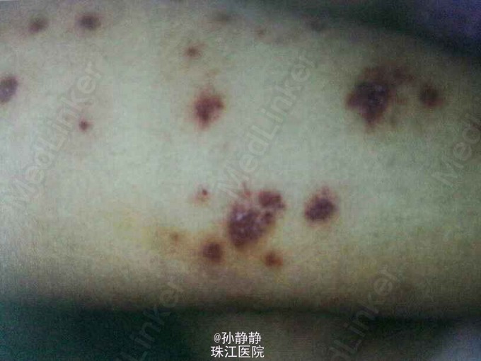 过敏性紫癜