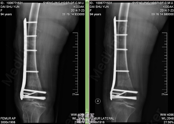 右股骨远端骨折（AO 33-C1）-医联