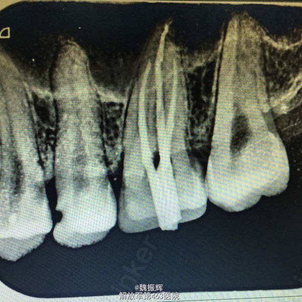 一次性根充