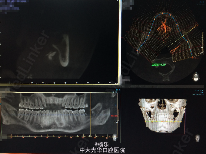 左下颌智齿拔除后掉入左咽旁间隙