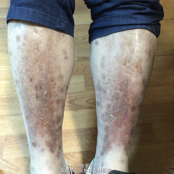 双小腿皮疹5年,躯干,双上肢,大腿皮疹1年余.
