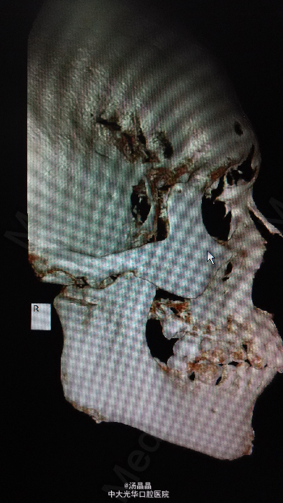双侧颞下颌关节强直病例