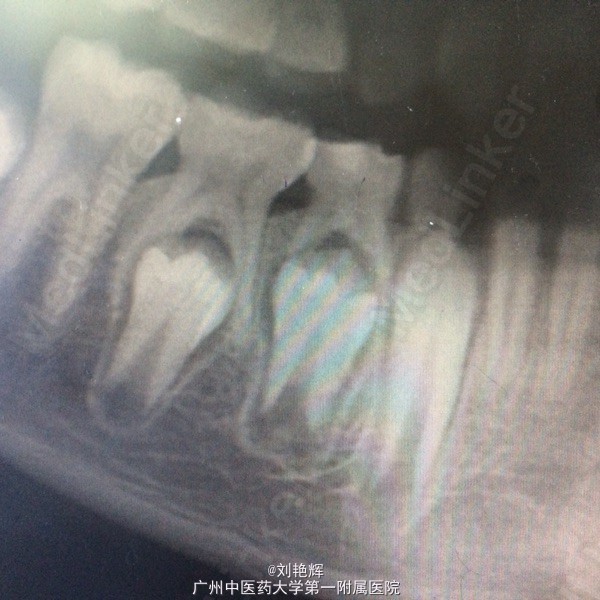 乳牙慢性根尖炎影响恒牙发育