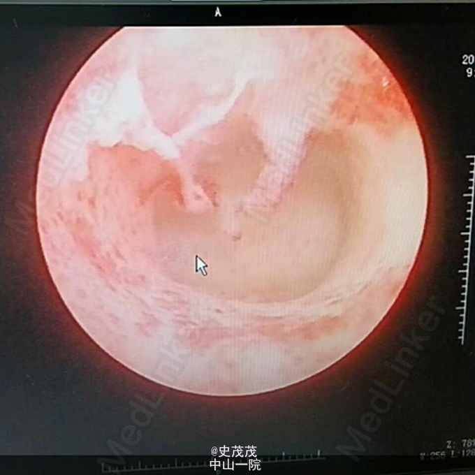 ivfet术前宫腔镜检查正常宫腔图