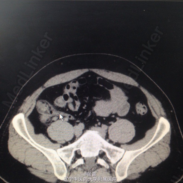 慢性阑尾炎合并盲肠憩室合并脂肪垂钙化