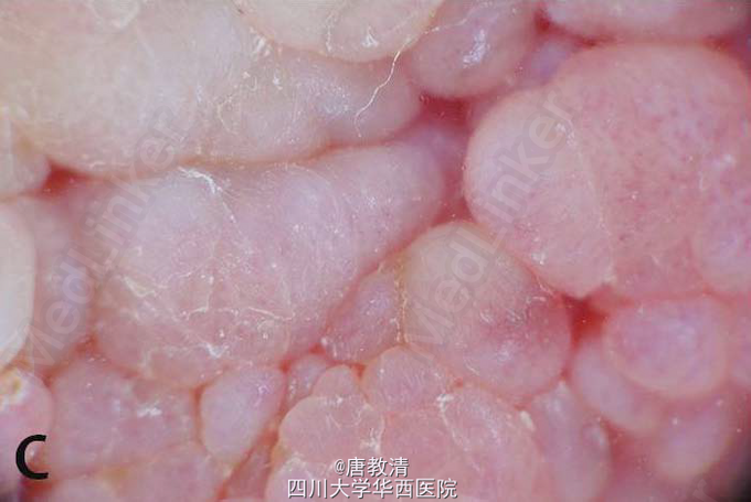 乳头菜花样赘生物为何?